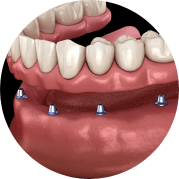 Am I eligible for dental implants