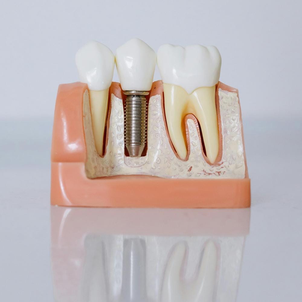 Benefits of dental implants