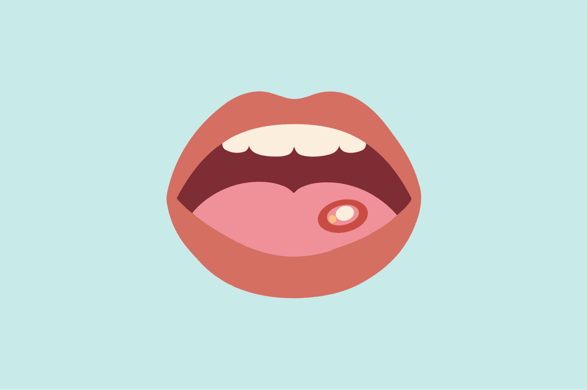 IU ulcer