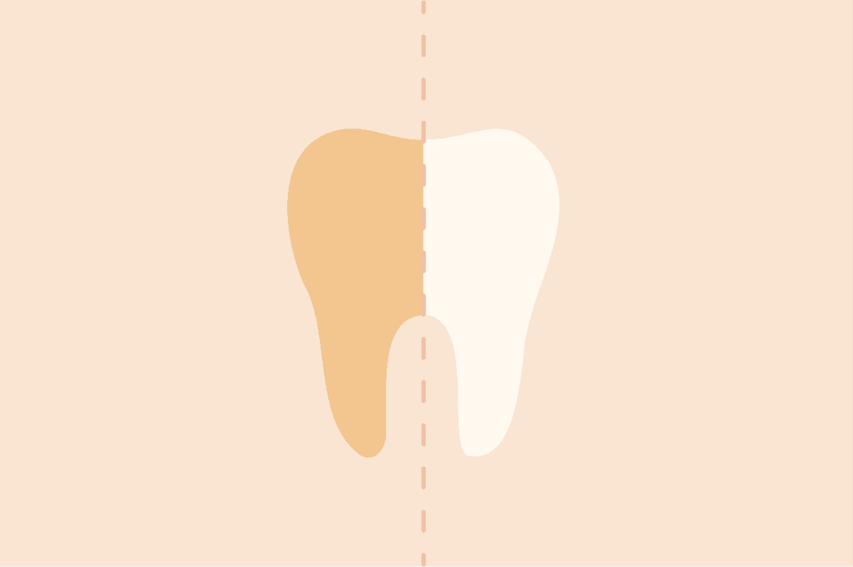 IU teeth whitening