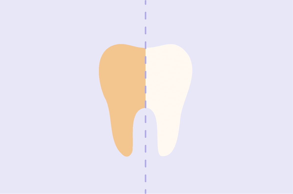 IU teeth whitening