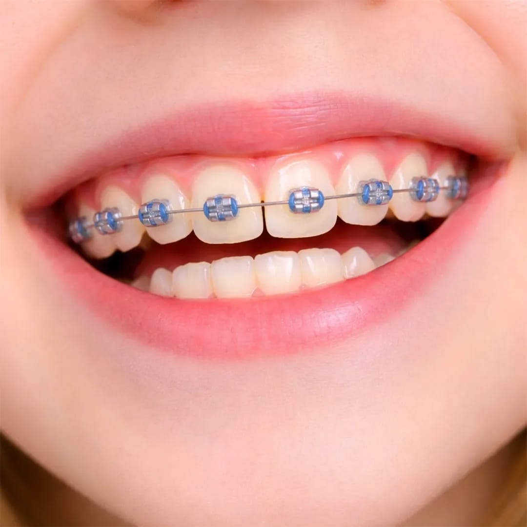 child_braces_orthodontics