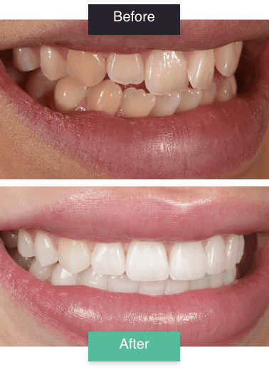 clera aligners before and after 01