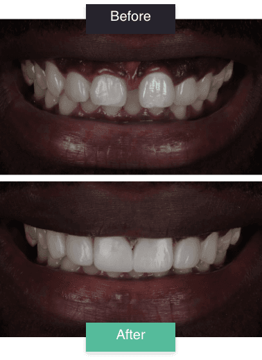 clear aligners before and after 02