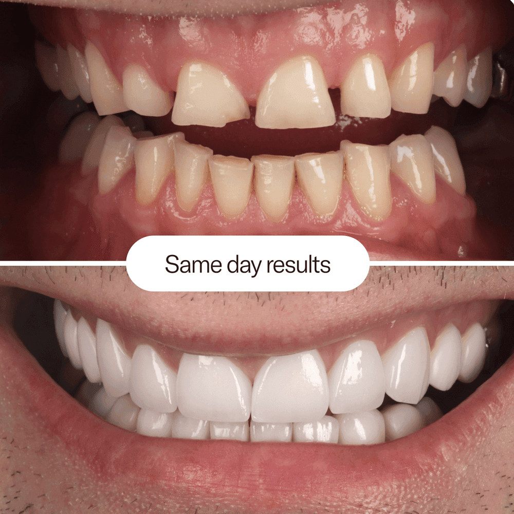 composite-bonding-before-and-after-example-1