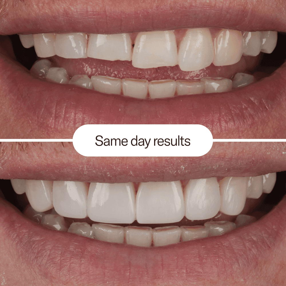 IU composite bonding before and after