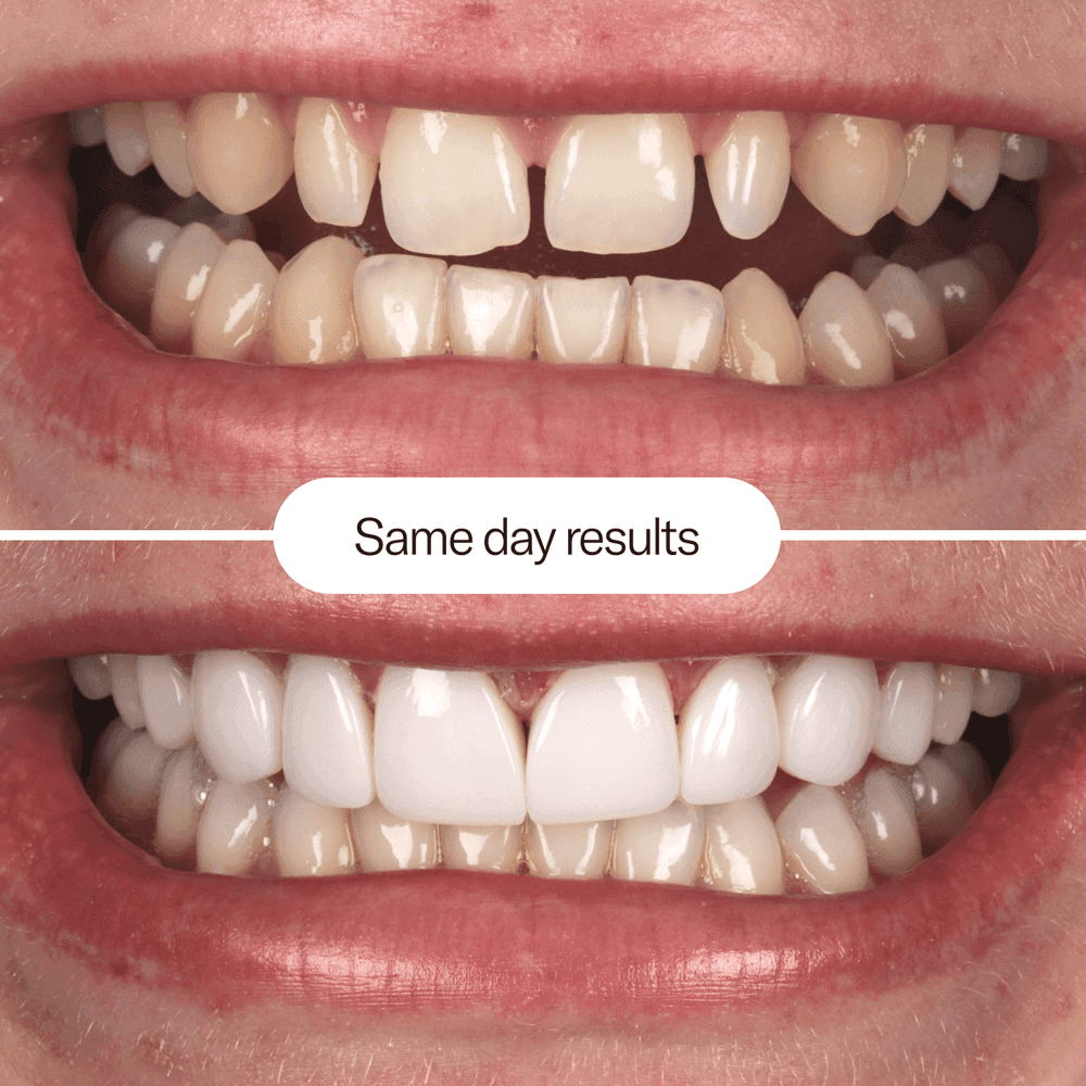 IU composite bonding before and after
