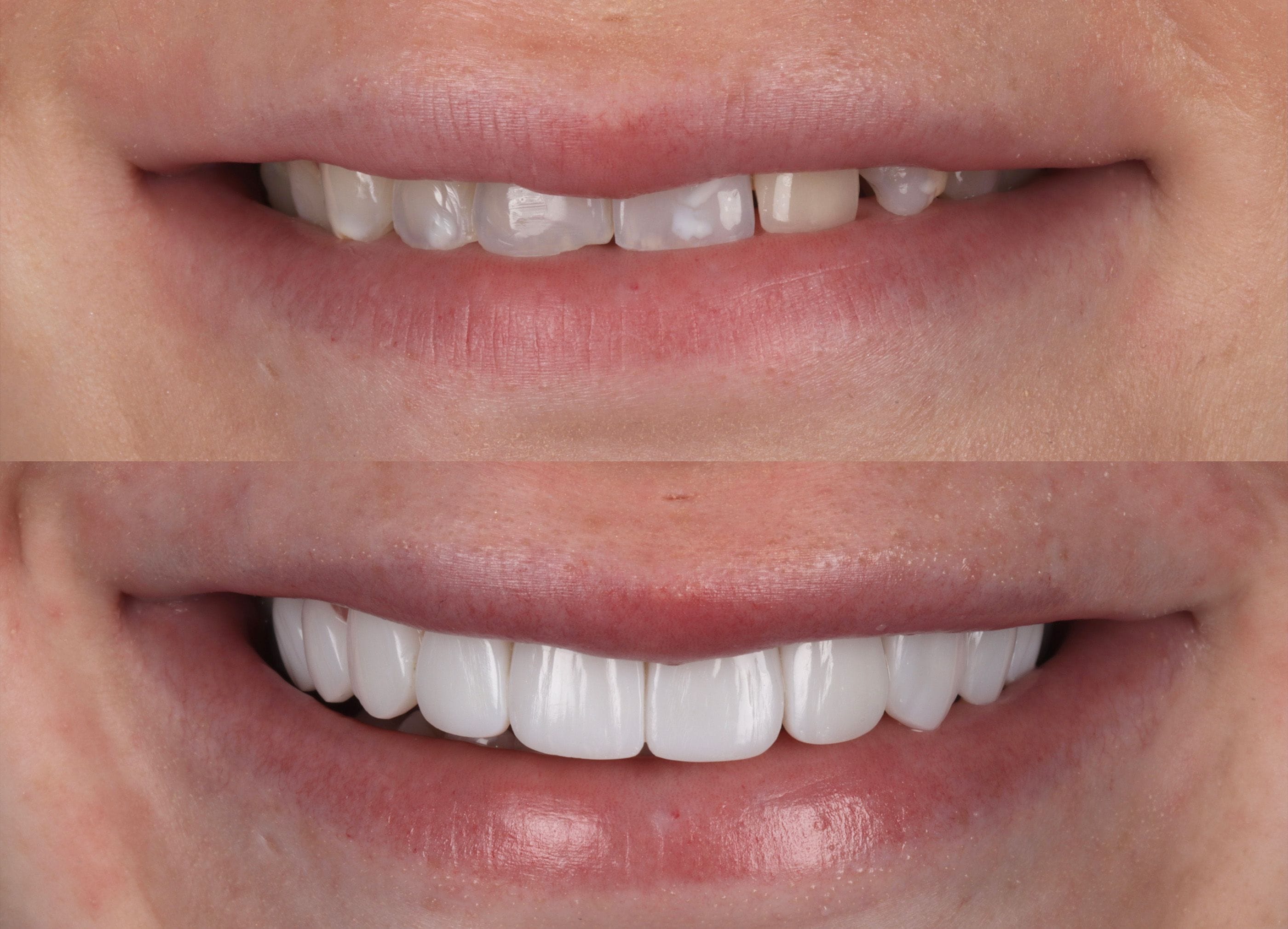 Composite bonding before and after photo