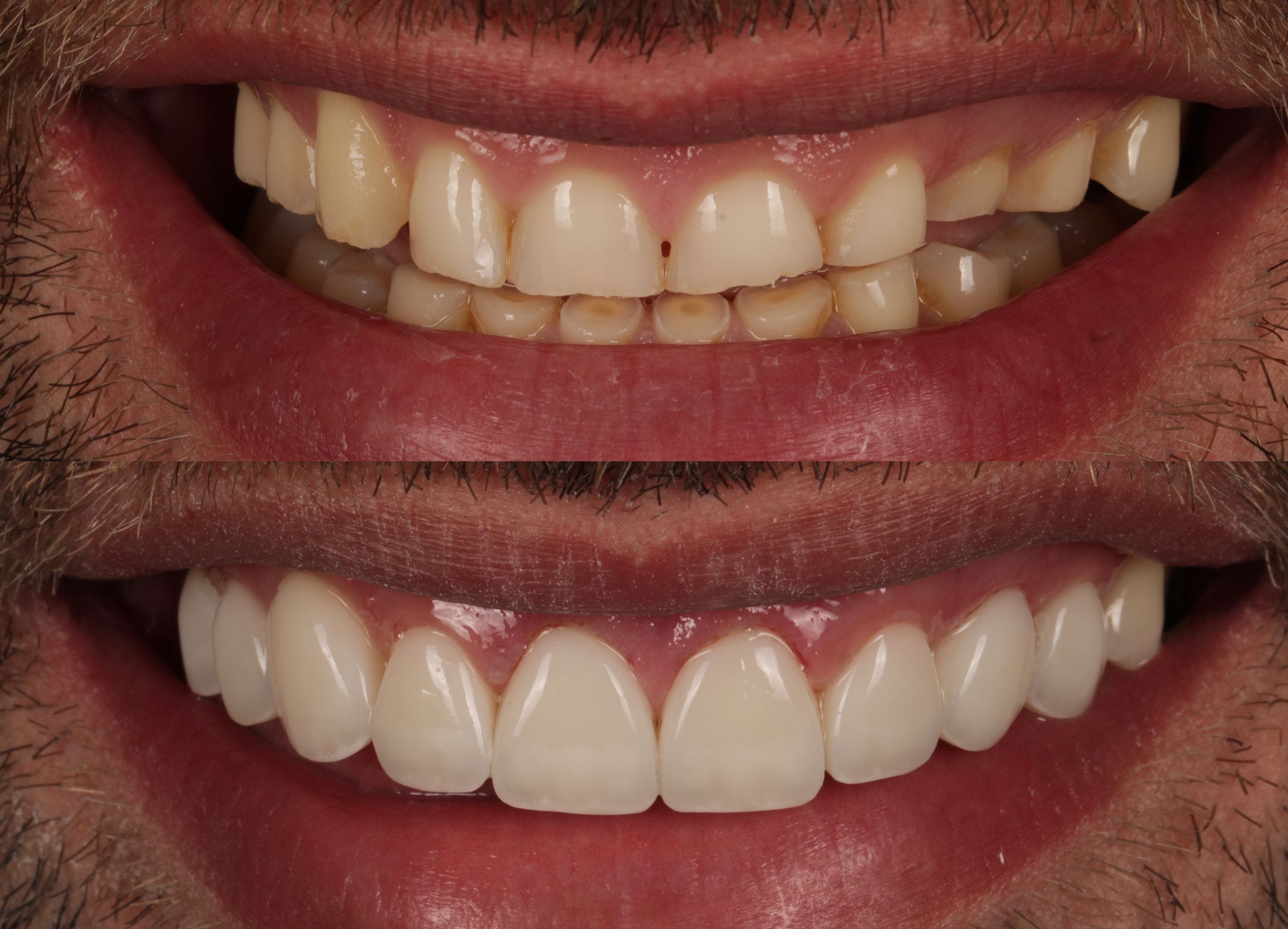 Composite bonding before and after photo