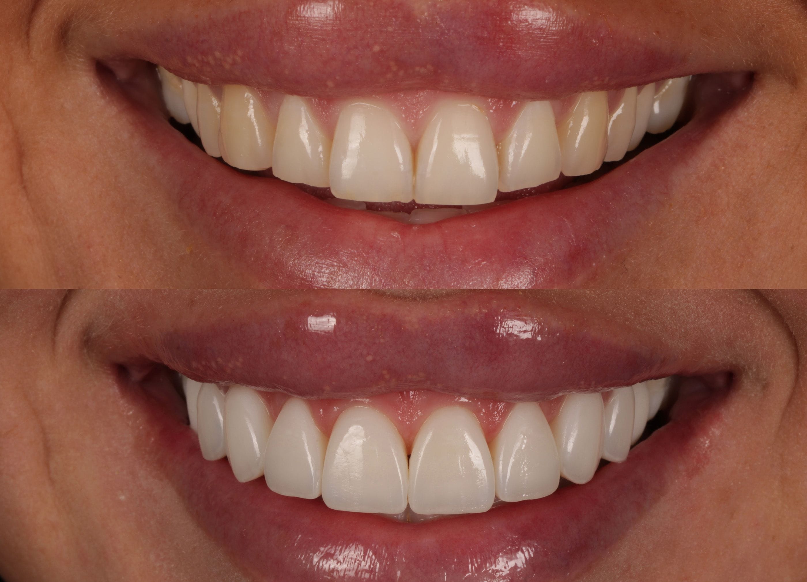 Composite bonding before and after photo