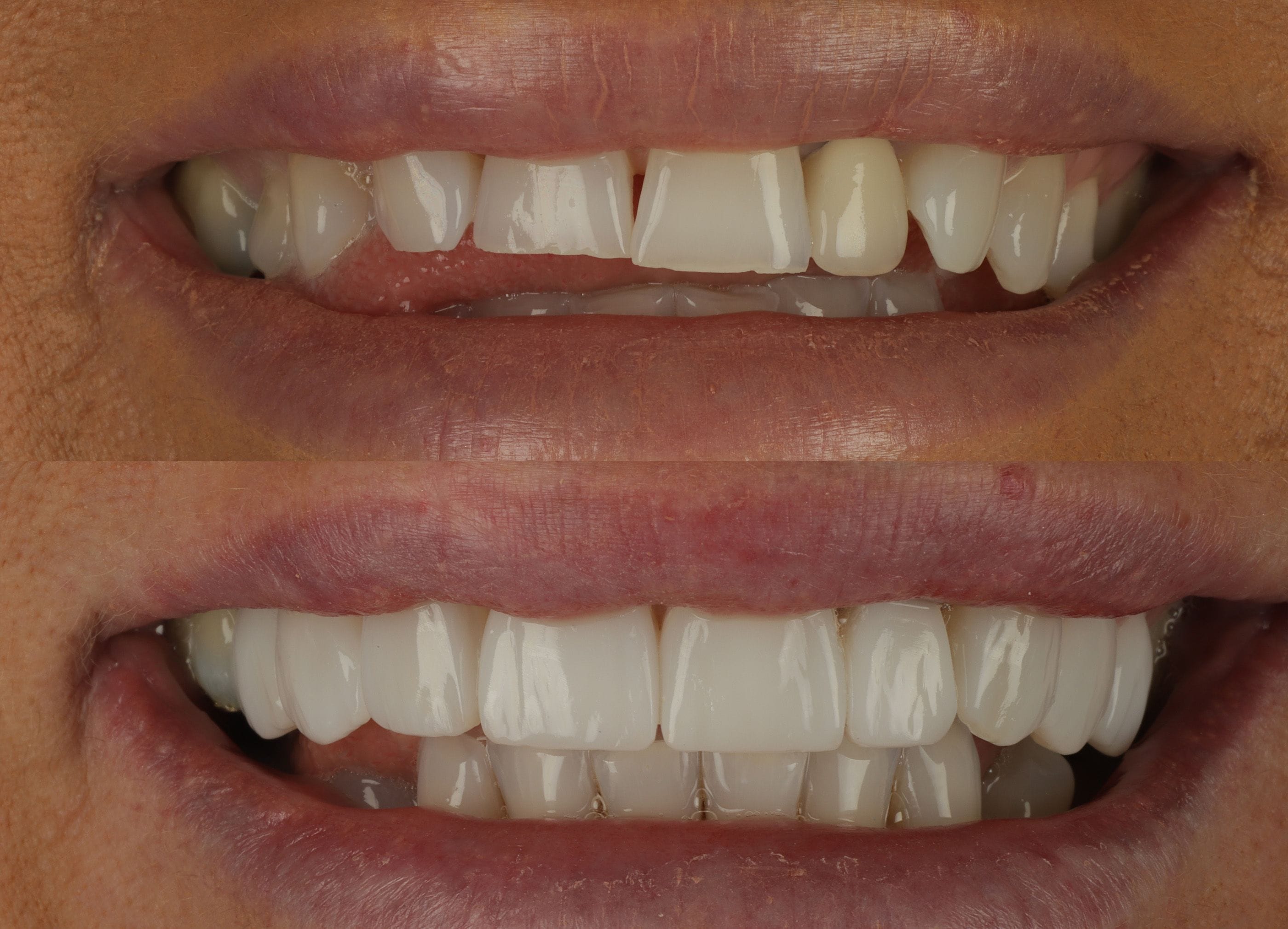 Composite bonding before and after photo