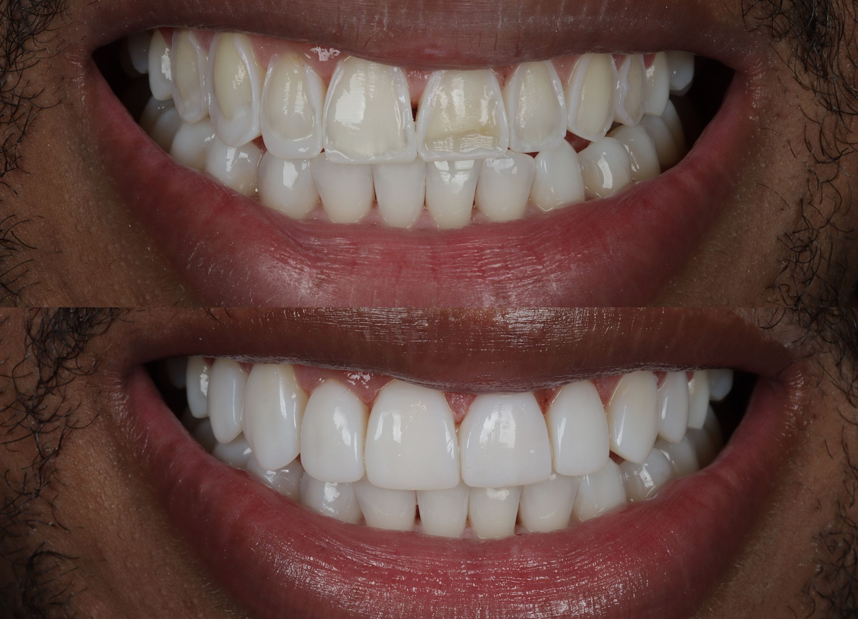 Composite bonding before and after photo
