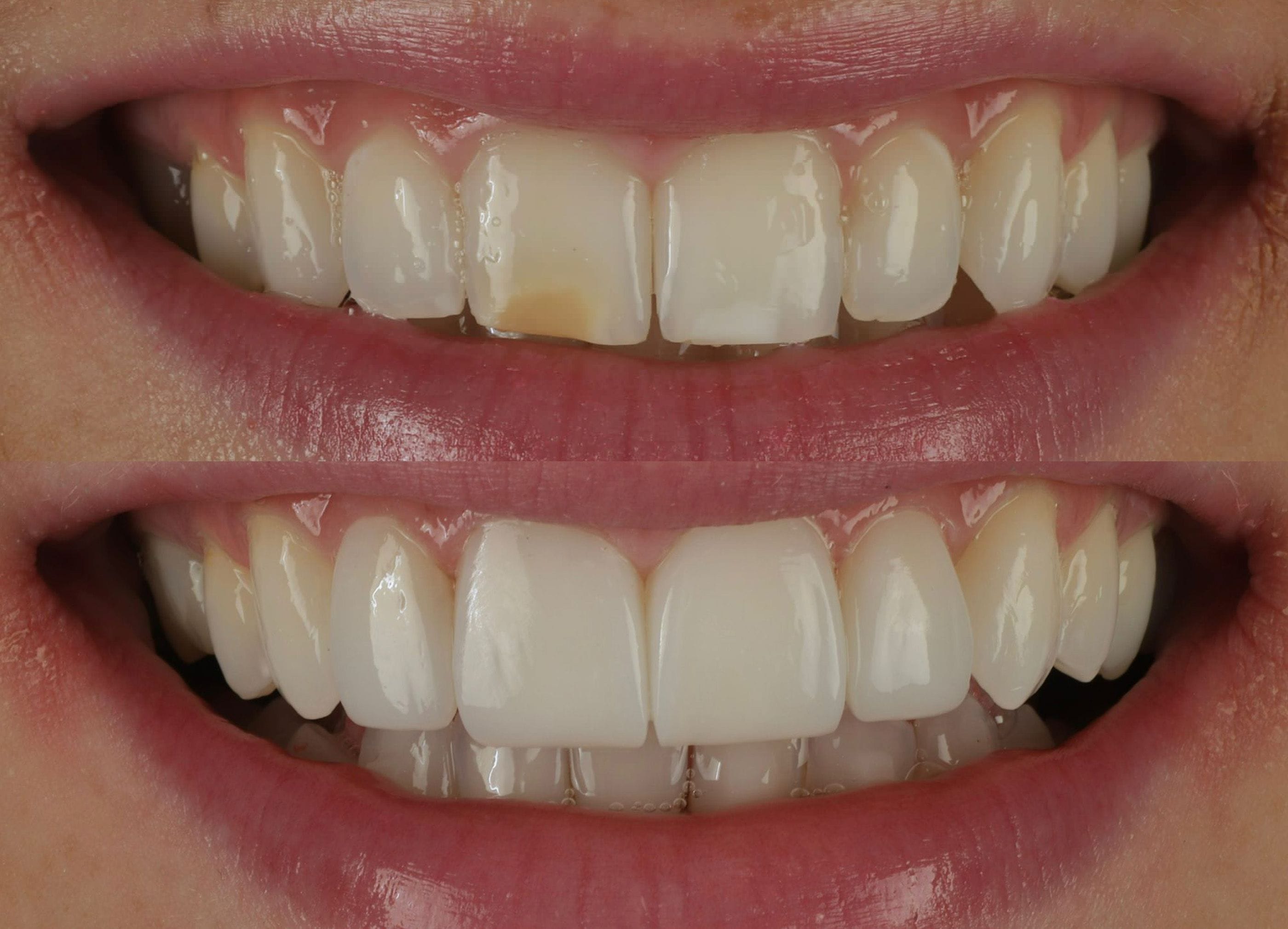 Composite bonding before and after photo