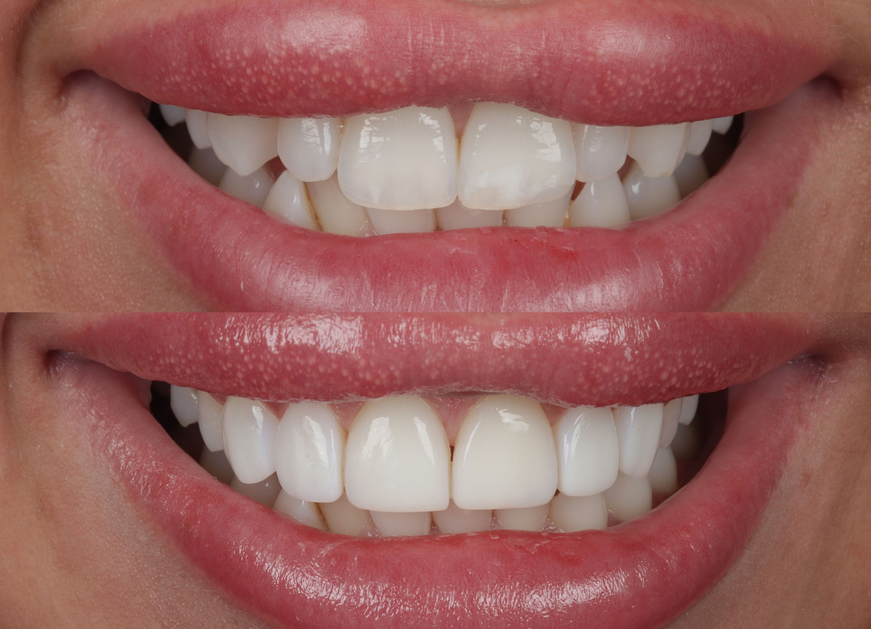 Composite bonding before and after photo