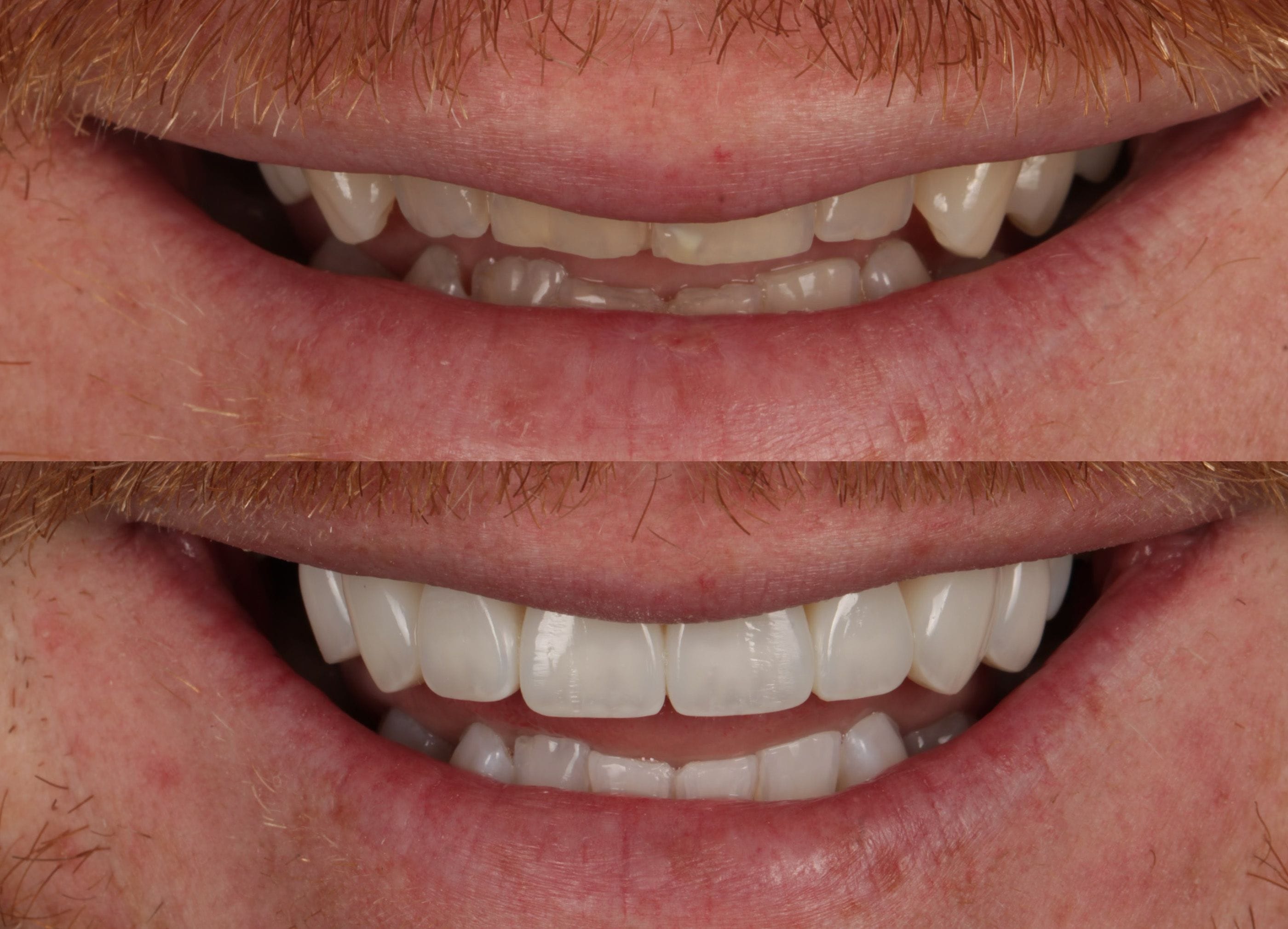 Composite bonding before and after photo