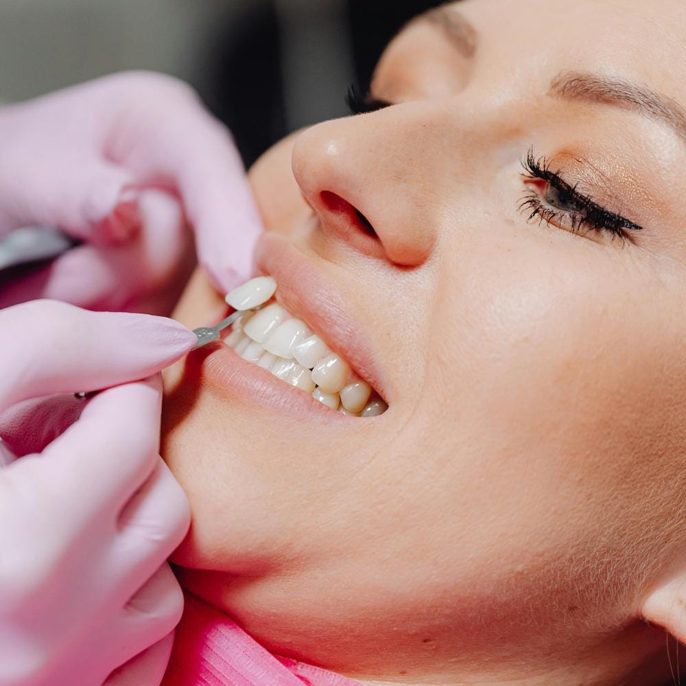 IU composite resin bonding vs veneers