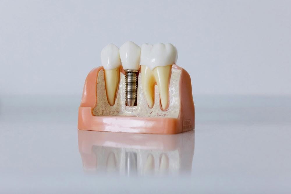 IU dental bridges vs dental implants