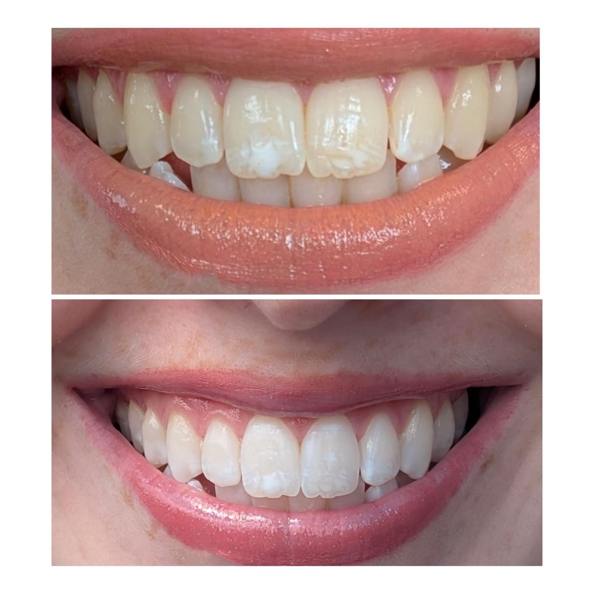 IU dental fluorosis before and after photo