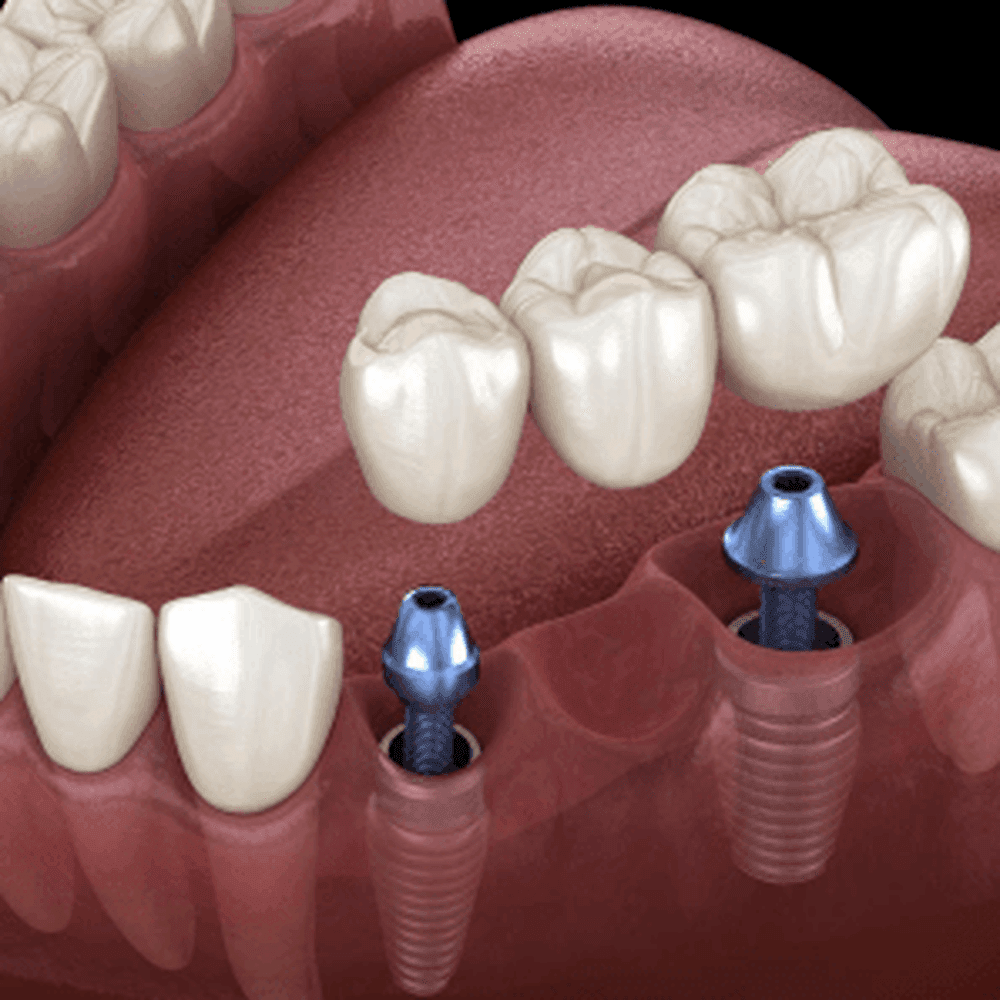 IU dental implant bridge