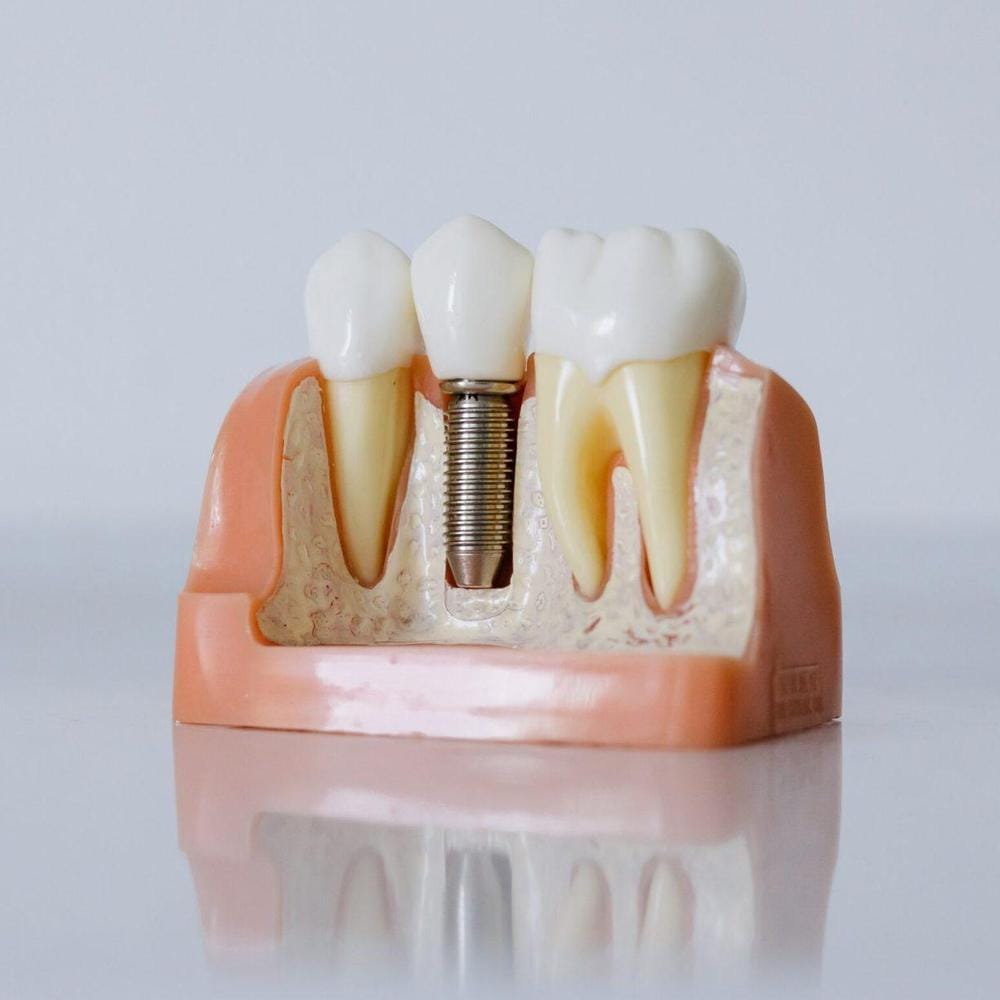 IU how much do dental implants cost in the UK