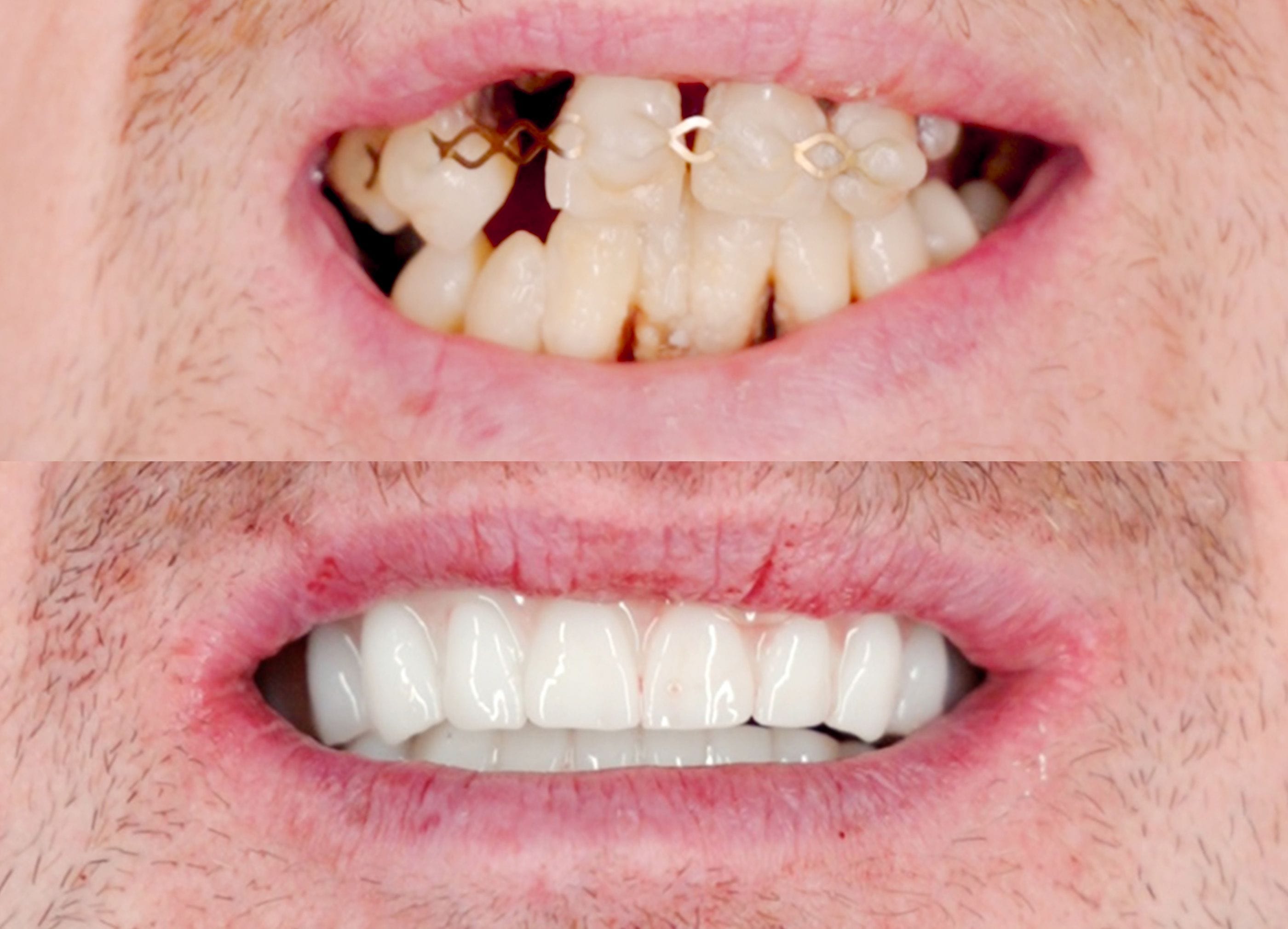Dental implants before and after