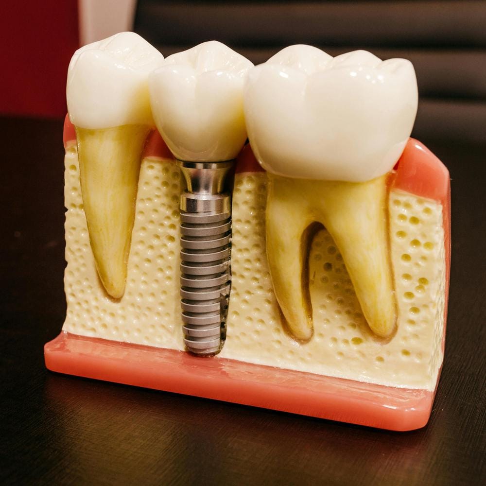 IU everything you need to know about dental implant LTP (long term prosthetic)