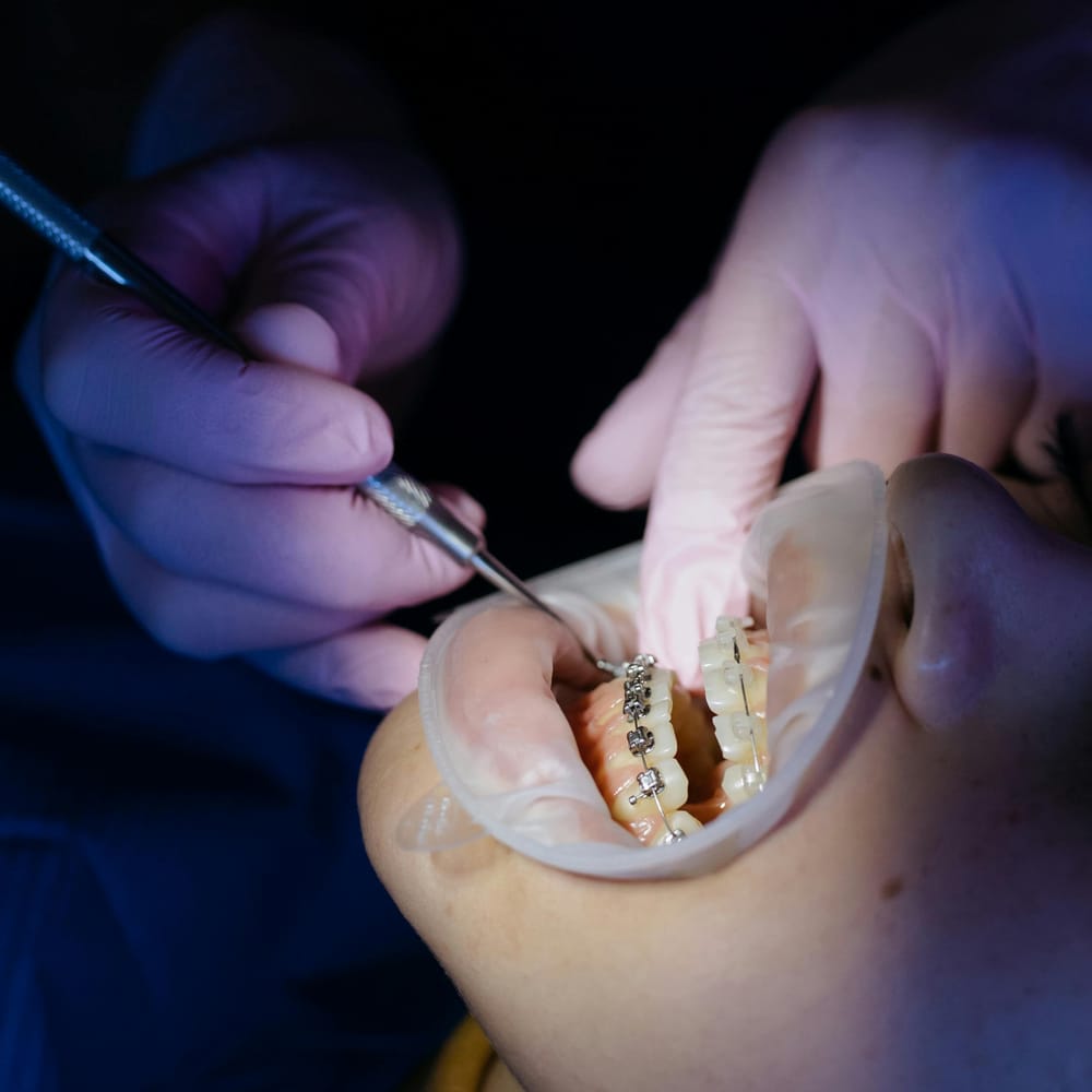getting-rid-of-white-marks-on-teeth-from-braces