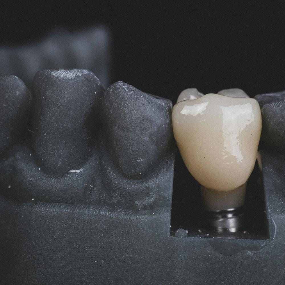 loose-dental-crown-symptoms