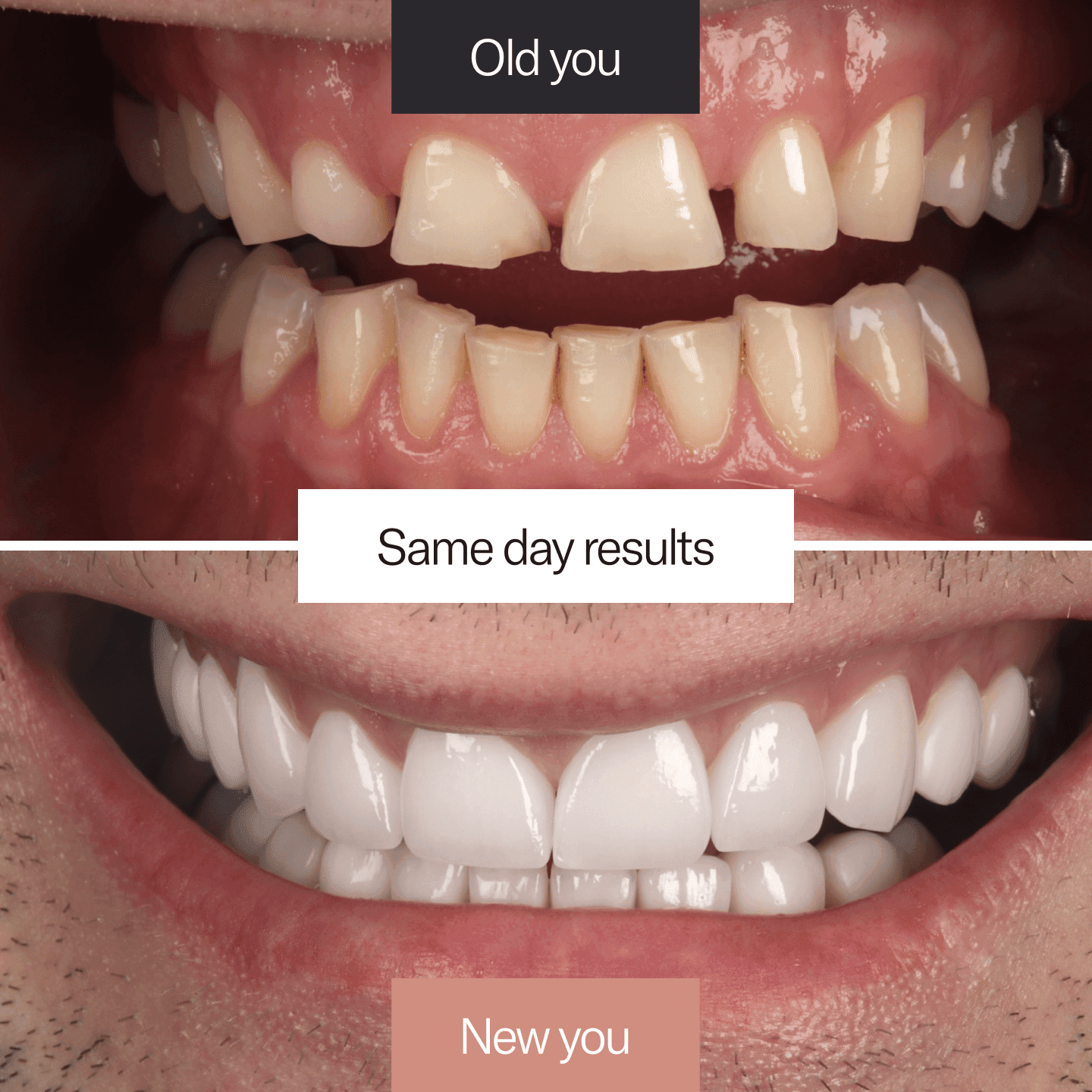 Composite bonding