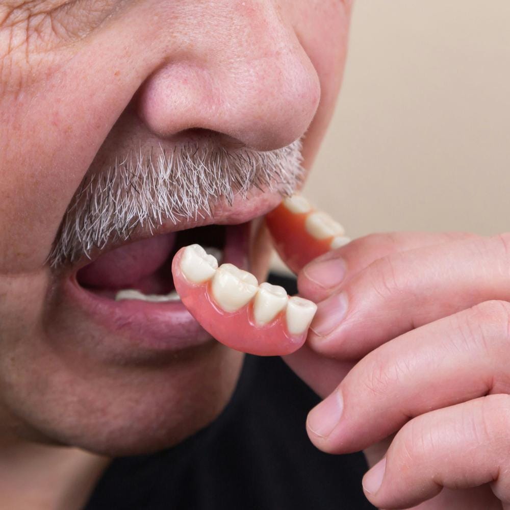 overdenture