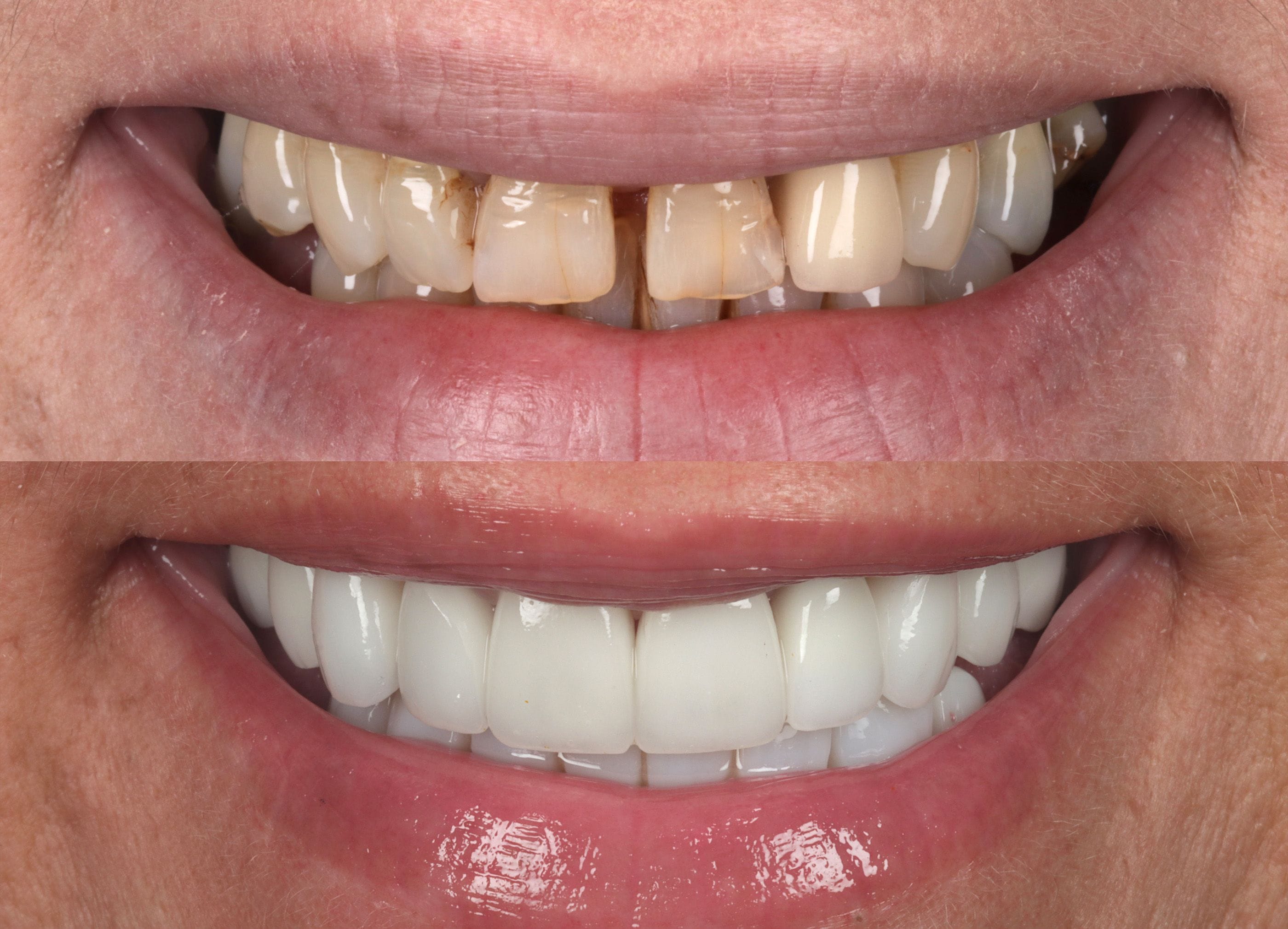 Porcelain veneers before and after