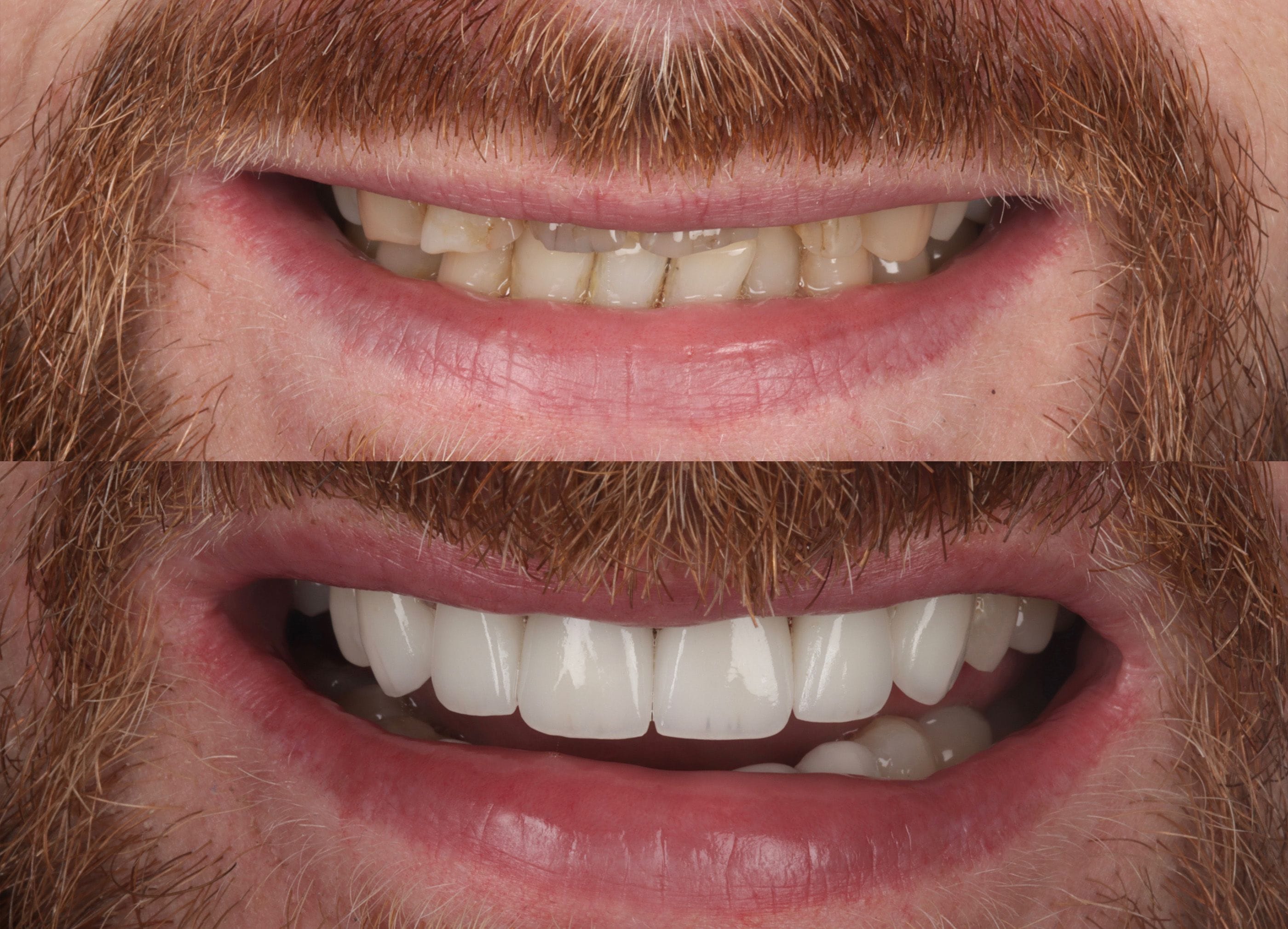 Porcelain veneers before and after