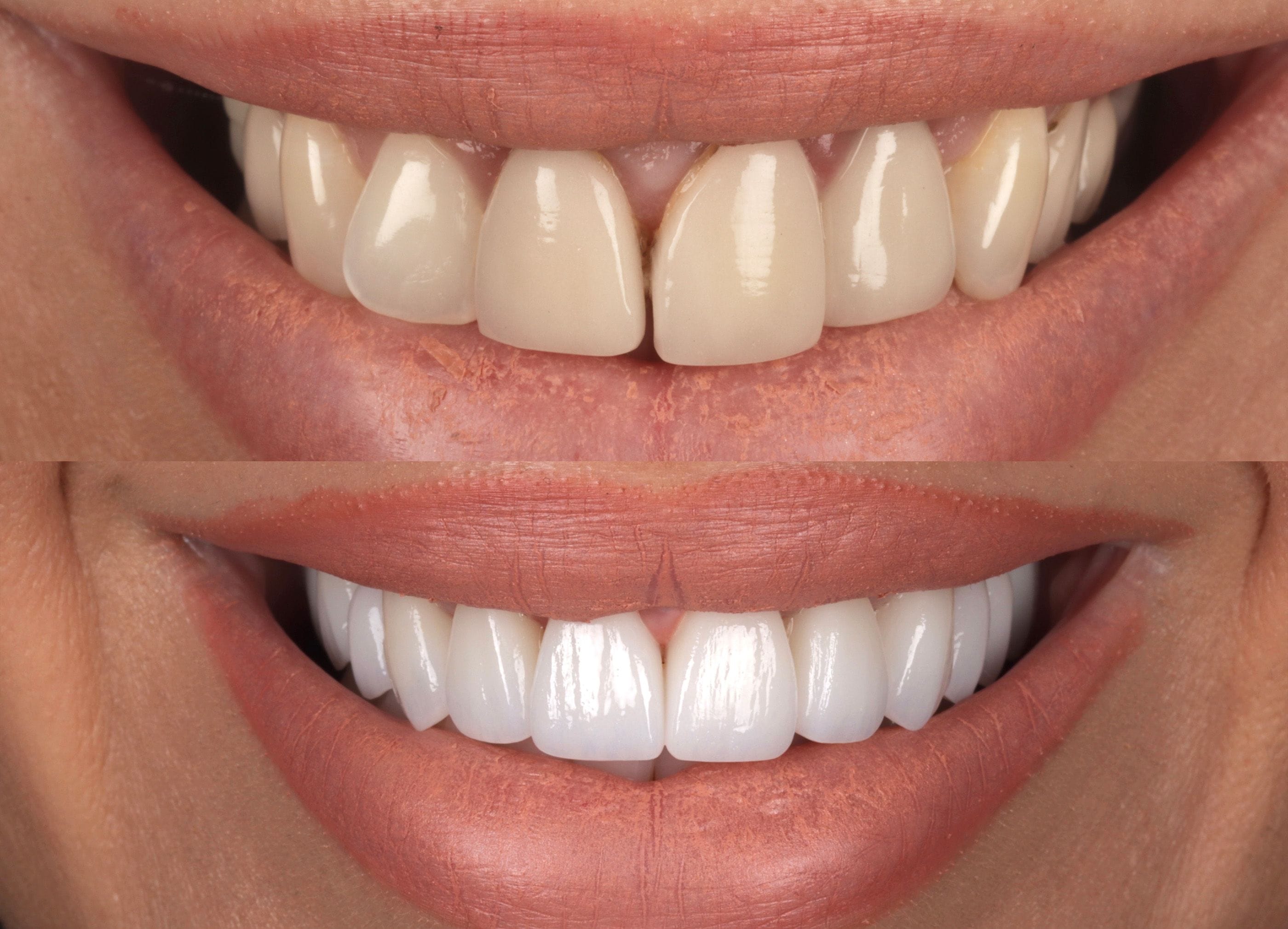 Porcelain veneers before and after