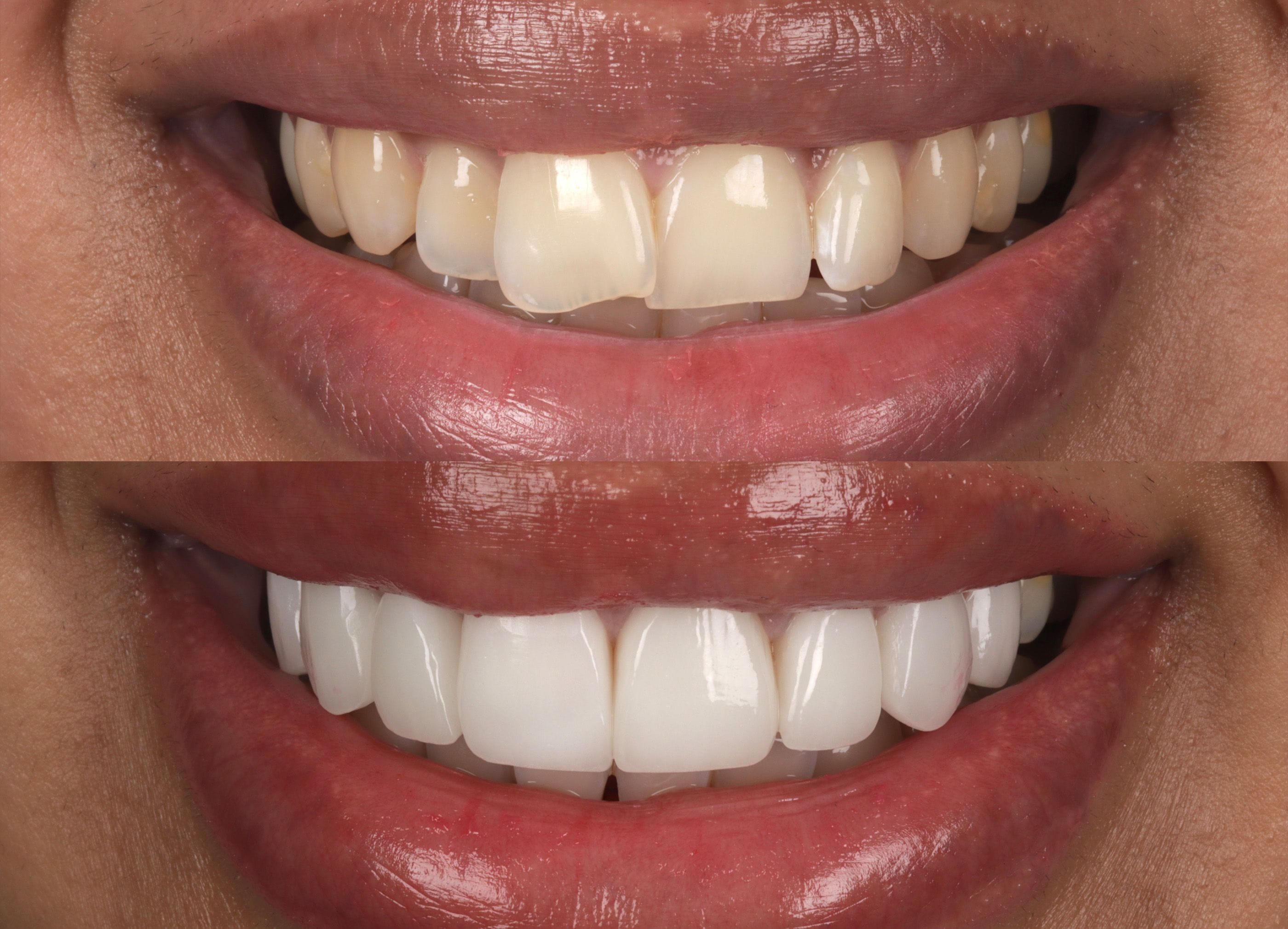 Porcelain veneers before and after