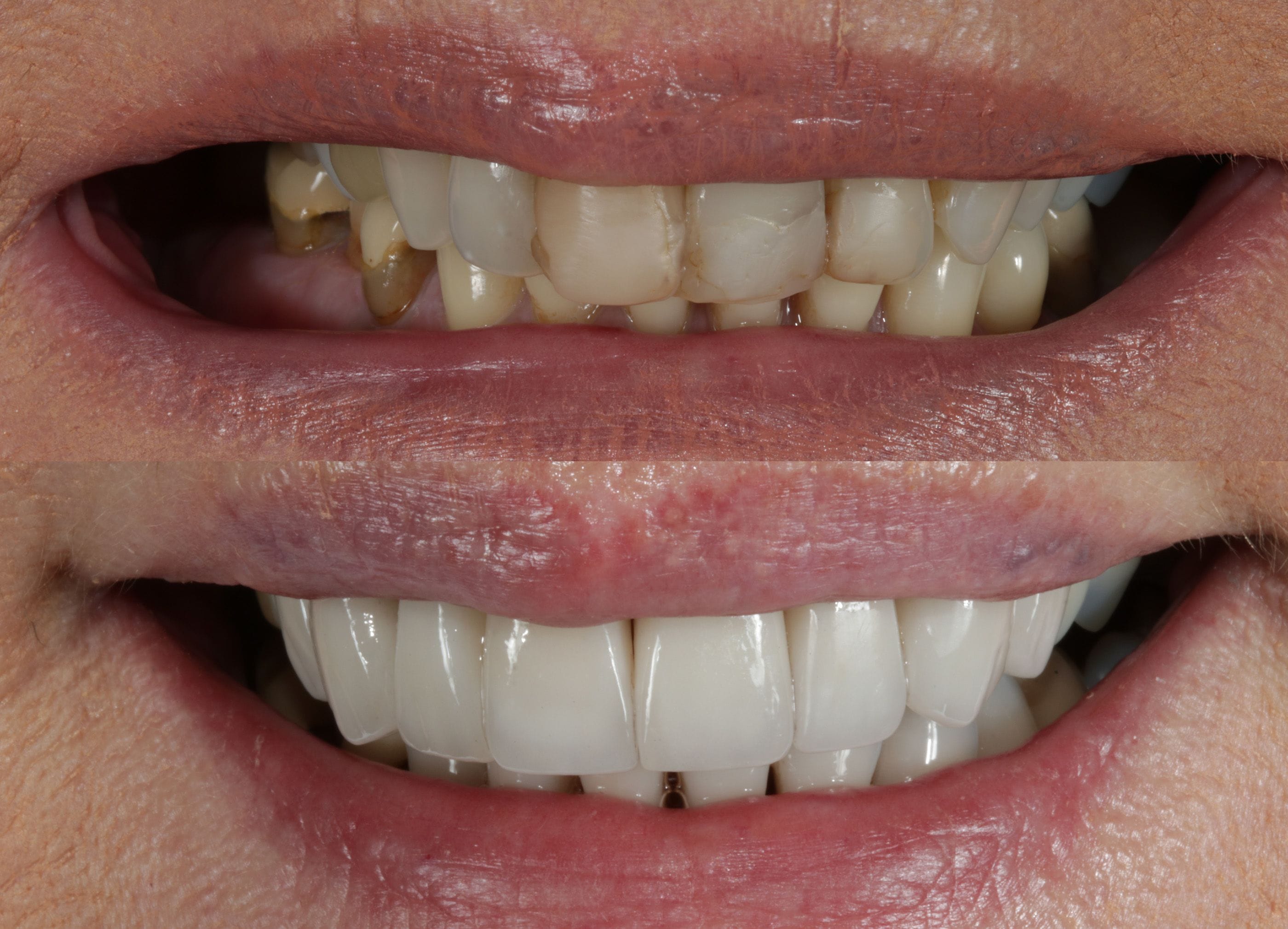 Porcelain veneers before and after