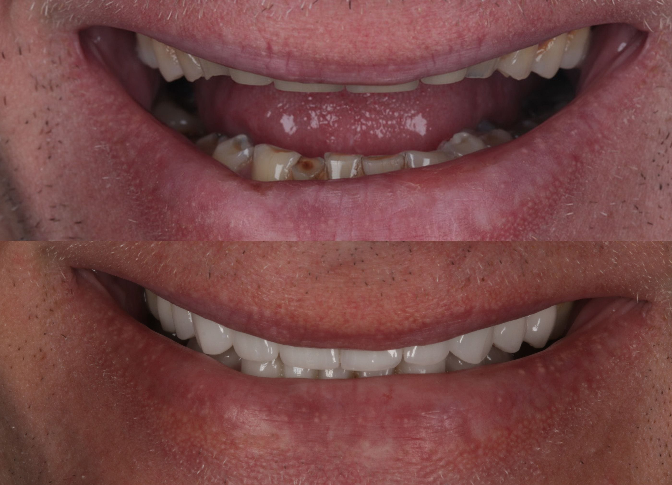 Porcelain veneers before and after