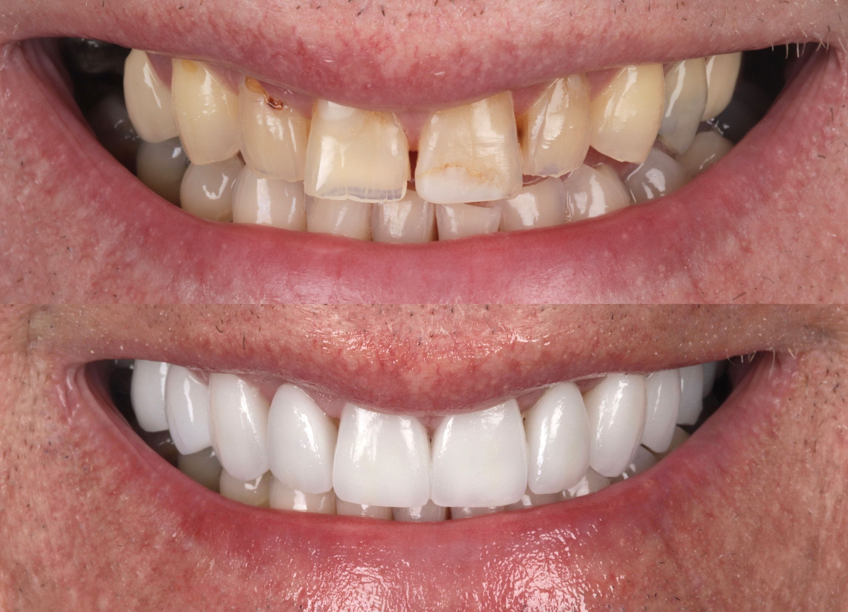 Porcelain veneers before and after