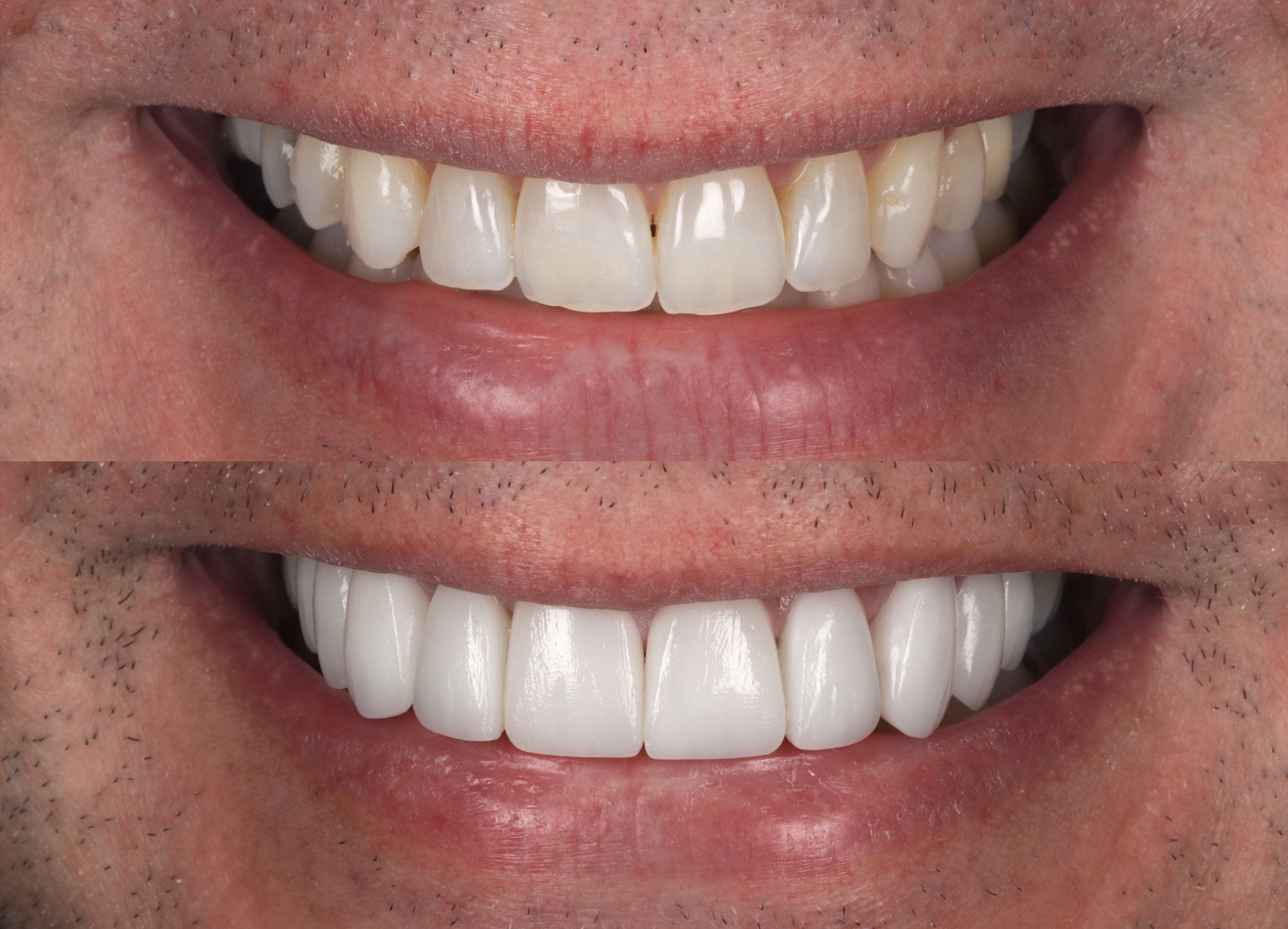 Porcelain veneers before and after