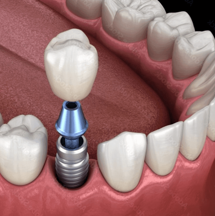 Implant Diagram