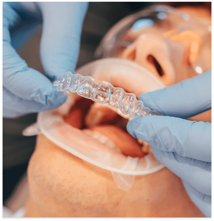 Aligner Fitment