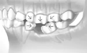 tooth-migration