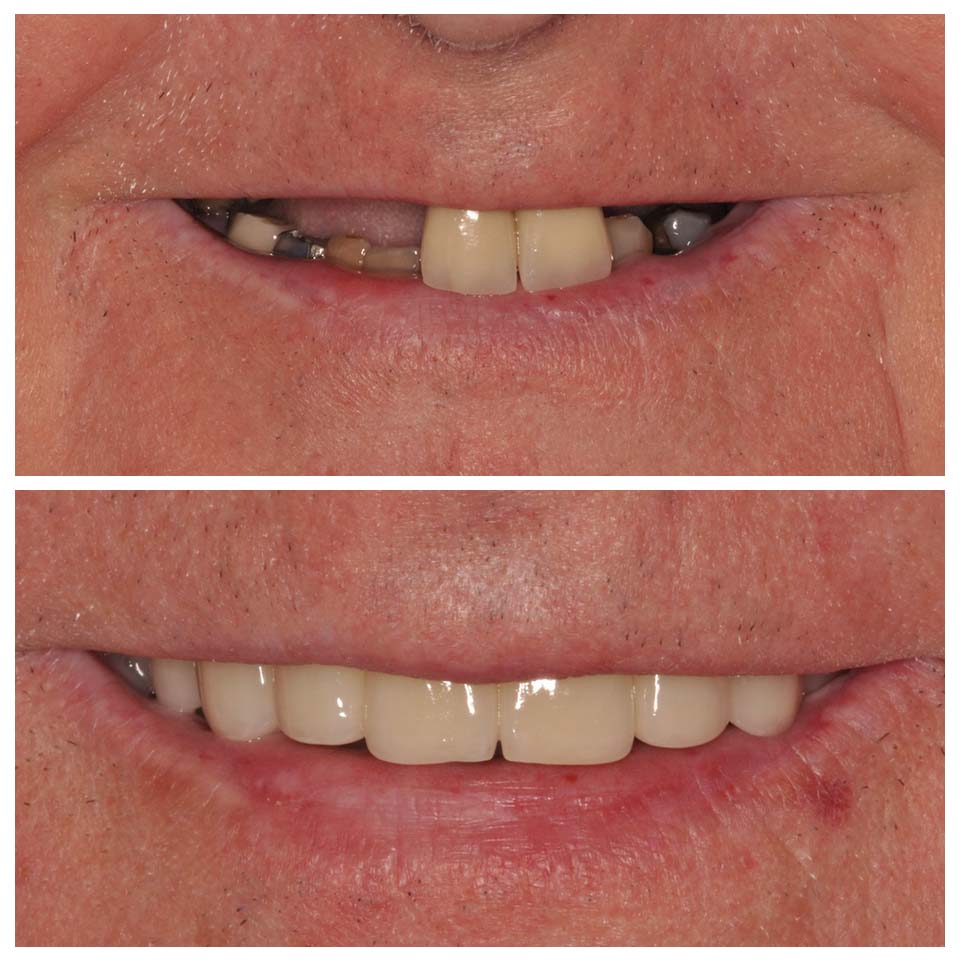 dental implants before and after