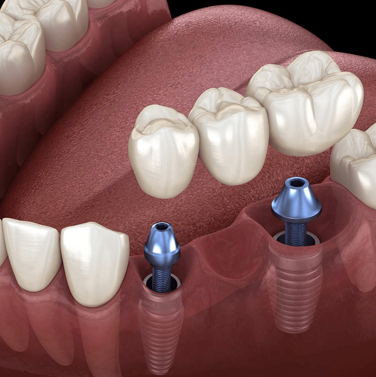 Multiple Implants Illustrration