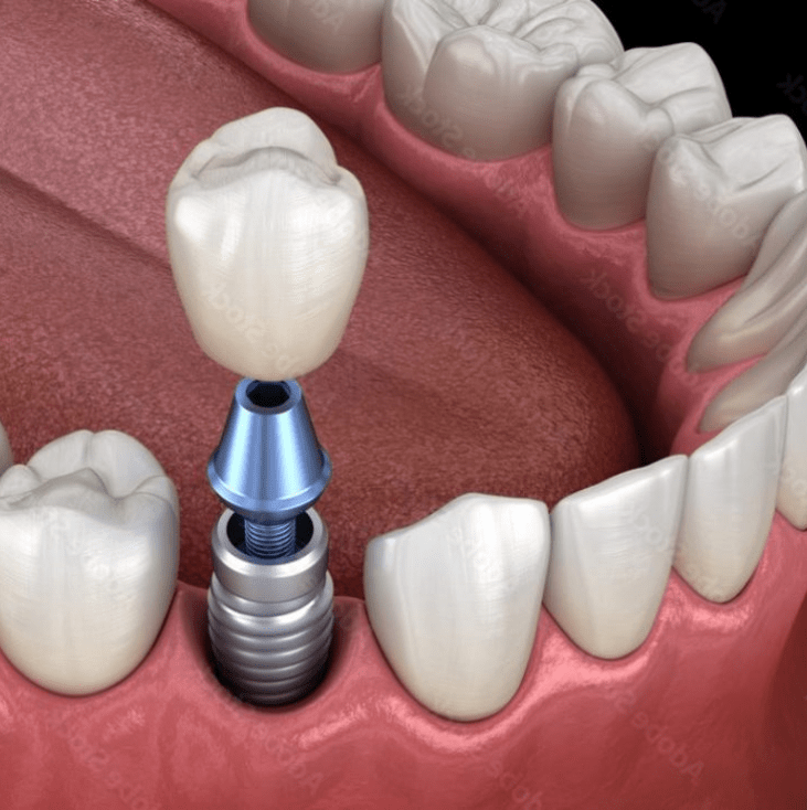 Implant Diagram