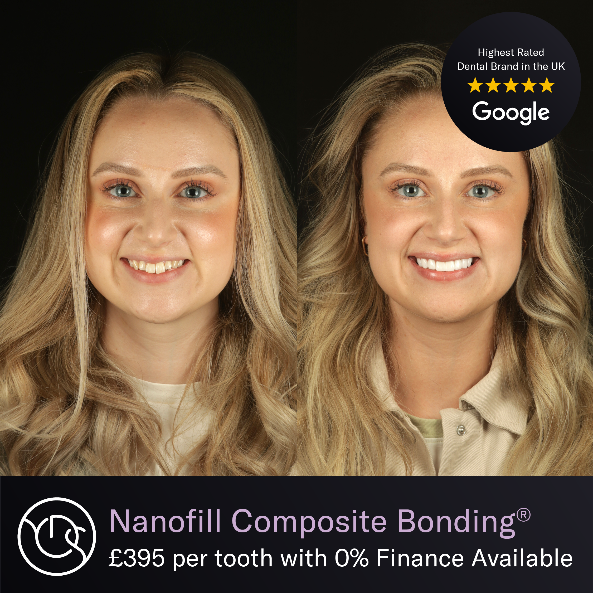 Nanofill Composite Bonding Before and After
