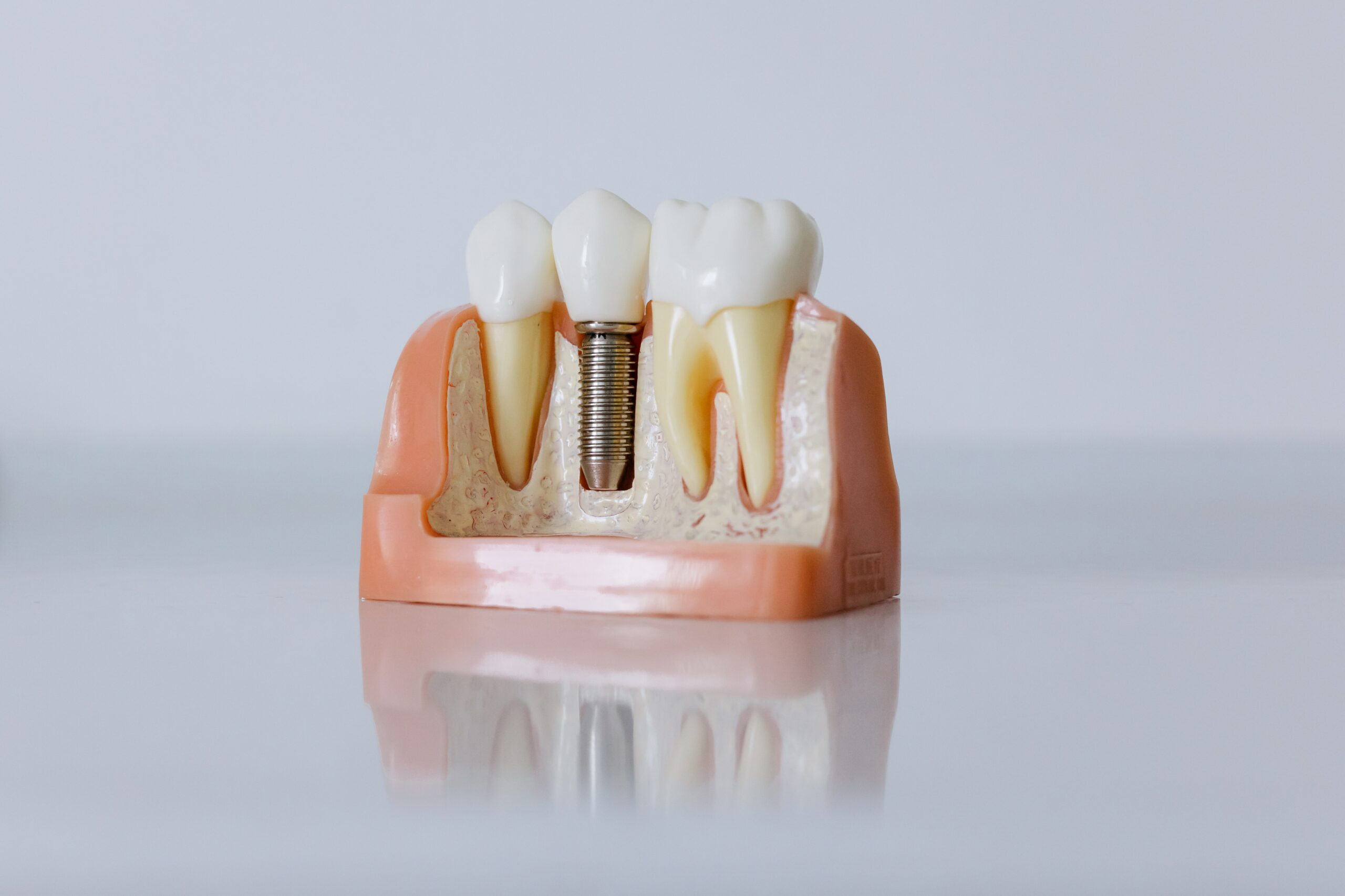 Dental Implant 3D