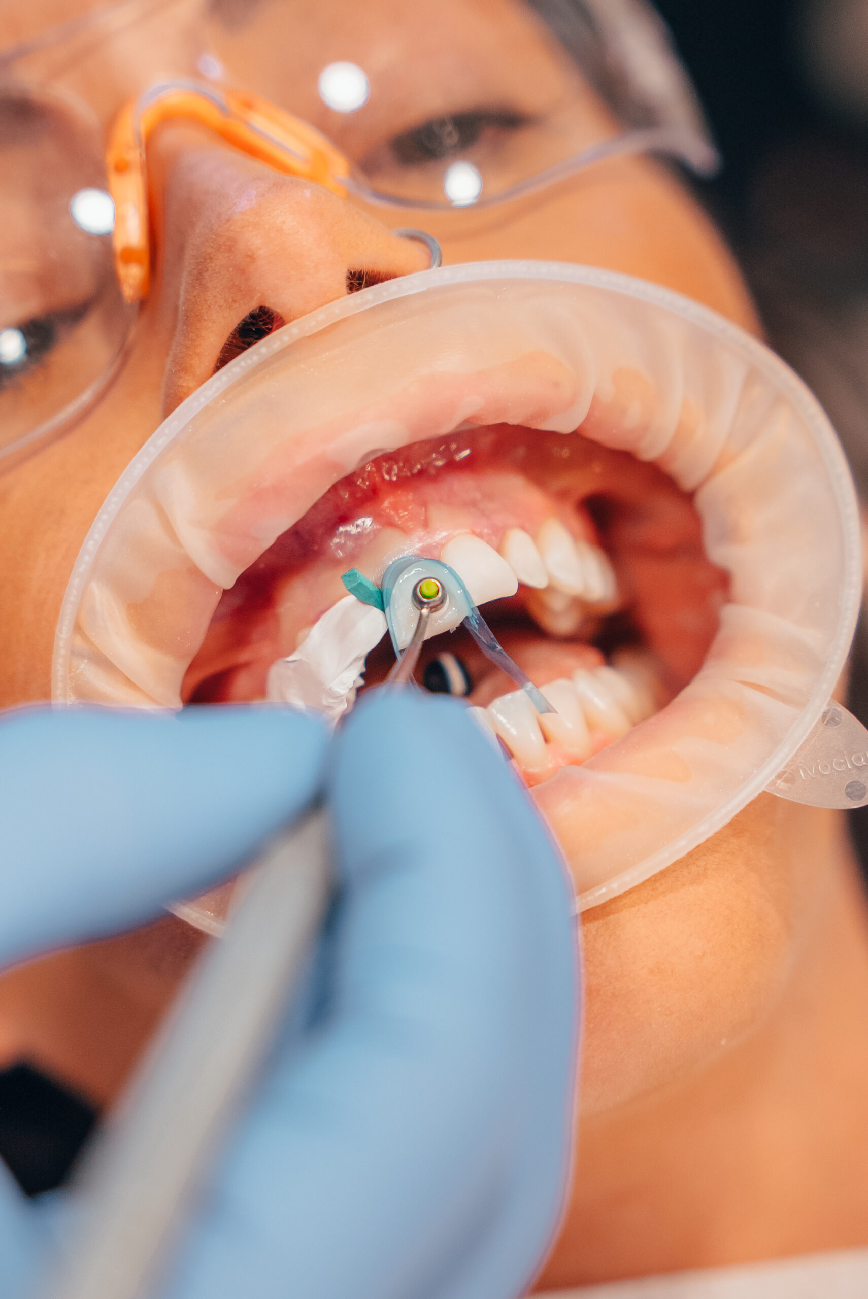 Close up of a patient's mouth while they are receiving the Nanofill Composite Bonding® cosmetic dentirsty treatment from Yorkshire Dental Suite.